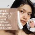 Microneedling For Acne Scars & Enlarged Pores: AFFORD Clinic In Al Nahda Dubai