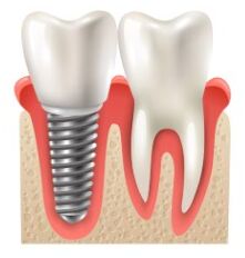 Mumbai, Dental, Dental Implants: A Long-Term Solution For Missing Teeth
