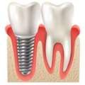 Dental Implants: A Long-Term Solution For Missing Teeth
