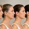 Facelift Surgery In Los Angeles &ndash; Natural Facial Rejuvenation
