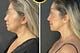 Los Angeles, Business, Facelift Surgery In Los Angeles &ndash; Natural Facial Rejuvenation