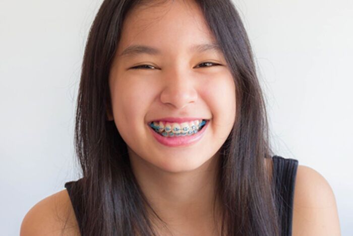 Toronto, Dental, Kids & Teen Orthodontics | Braces & Treatment | Smile Squad