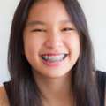 Kids & Teen Orthodontics | Braces & Treatment | Smile Squad