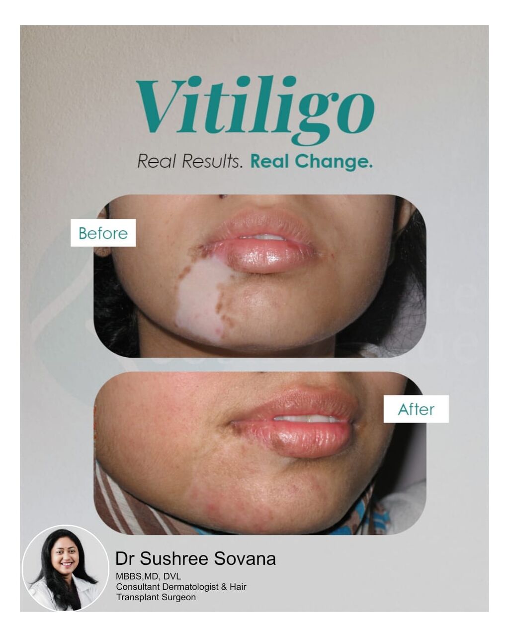Visakhapatnam, Health, Best Vitiligo Treatment - Derma One Vizag