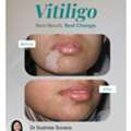 Best Vitiligo Treatment - Derma One Vizag