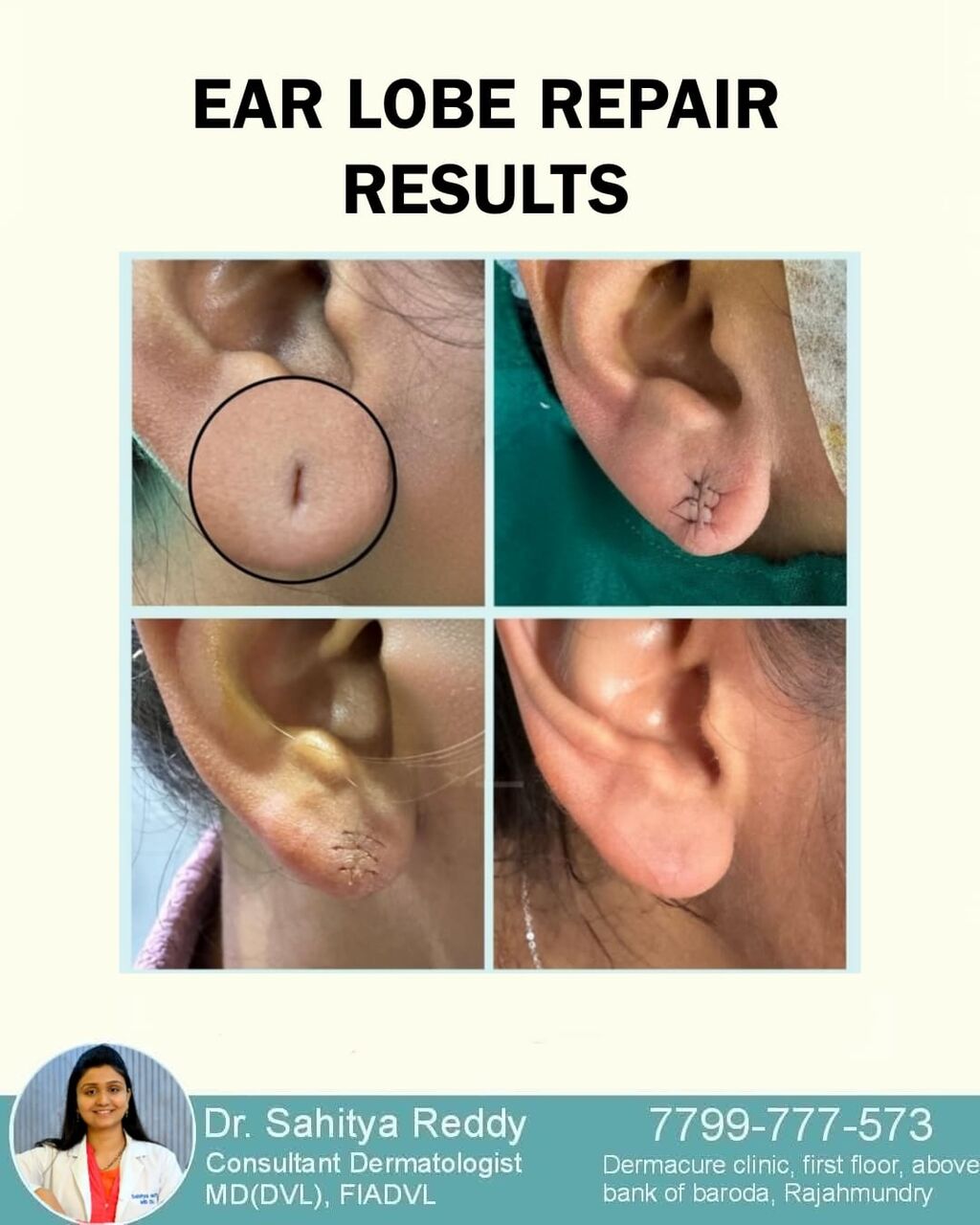 Kurnool, Health, Ear Lobe Repair Treatment - Dermacure Clinic