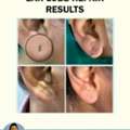 Ear Lobe Repair Treatment - Dermacure Clinic