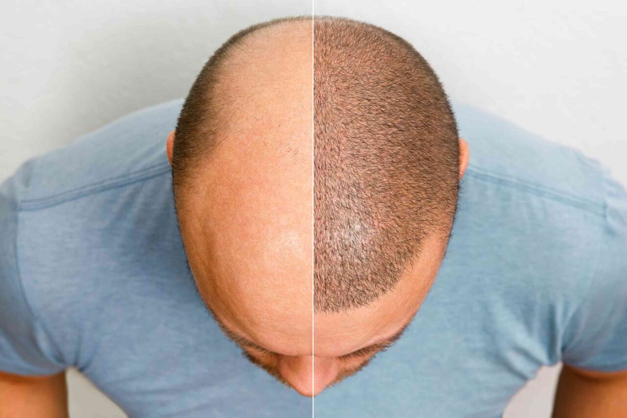 Noida, Health, Experienced Hair Fall Doctor In Noida &ndash; Personalized Treatment