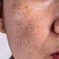 Advanced Pigmentation Treatment In Noida &ndash; Expert Skin Care