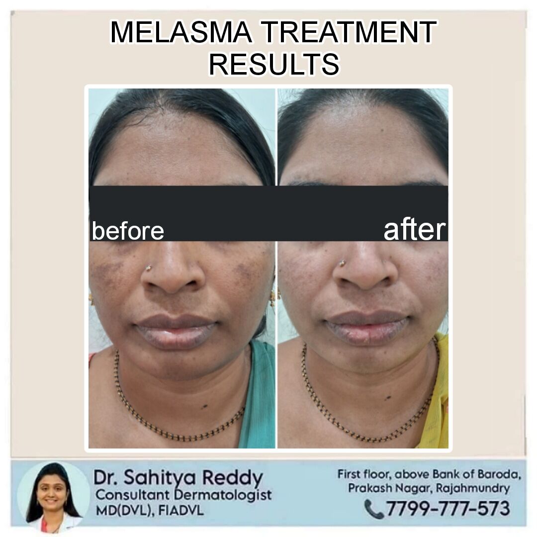 Kurnool, Health, Melasma Treatment At Dermacure Clinic - Rajahmundry