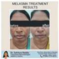 Melasma Treatment At Dermacure Clinic - Rajahmundry