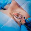 LASIK Eye Surgery In Faridabad For Clearer Vision