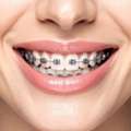 What Is The Cost Of Traditional Metal Braces?