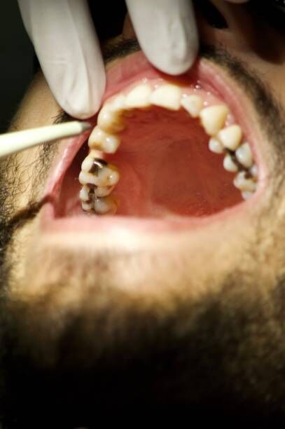 New York, Health, Composite Resin Fillings For A Natural-Looking Smile