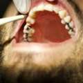 Composite Resin Fillings For A Natural-Looking Smile