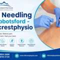 Dry Needling In Abbotsford - Hillcrestphysio