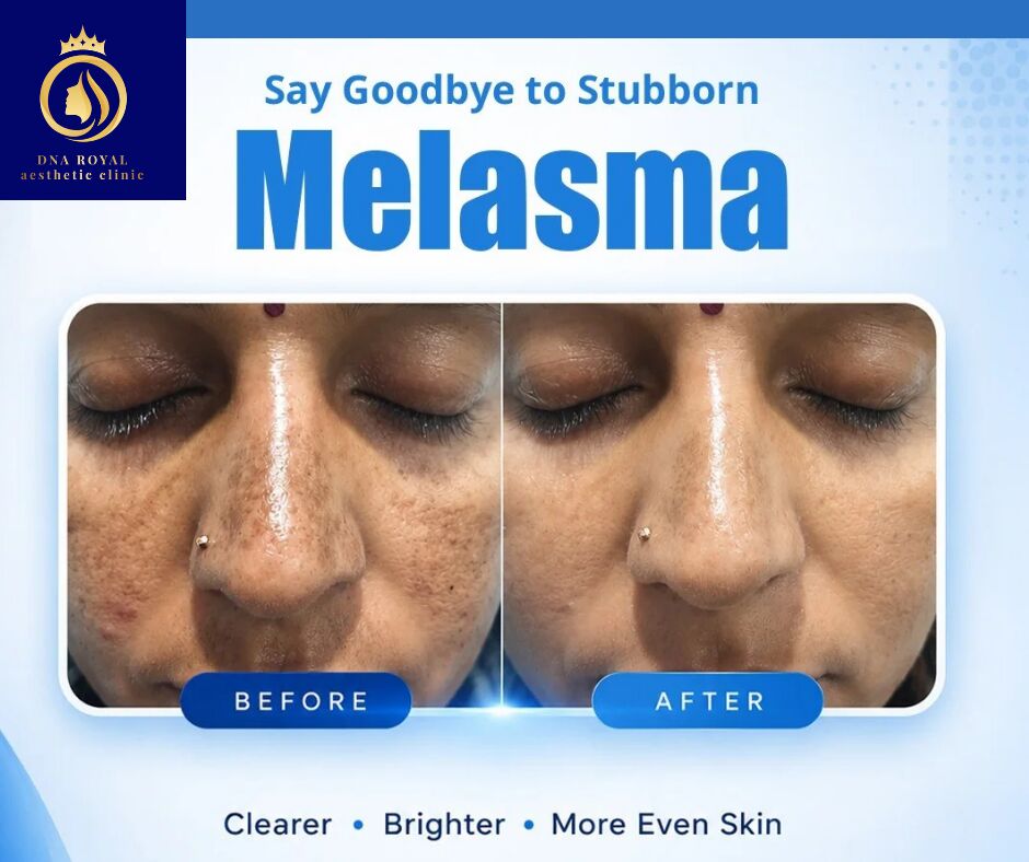 Thane, Fashion & Design, Transform Your Skin With The Best Melasma Treatment In Thane | DNA Royal.