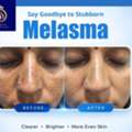 Transform Your Skin With The Best Melasma Treatment In Thane | DNA Royal.