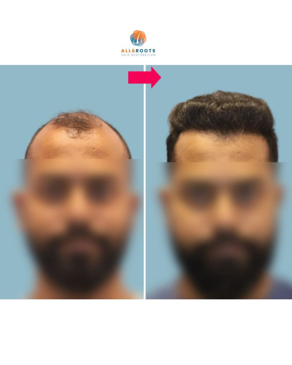 Bhubaneswar, Health, Best Hair Transplant Doctor In Bhubaneswar | Advanced Hair Restoration Clinic | Alloroots