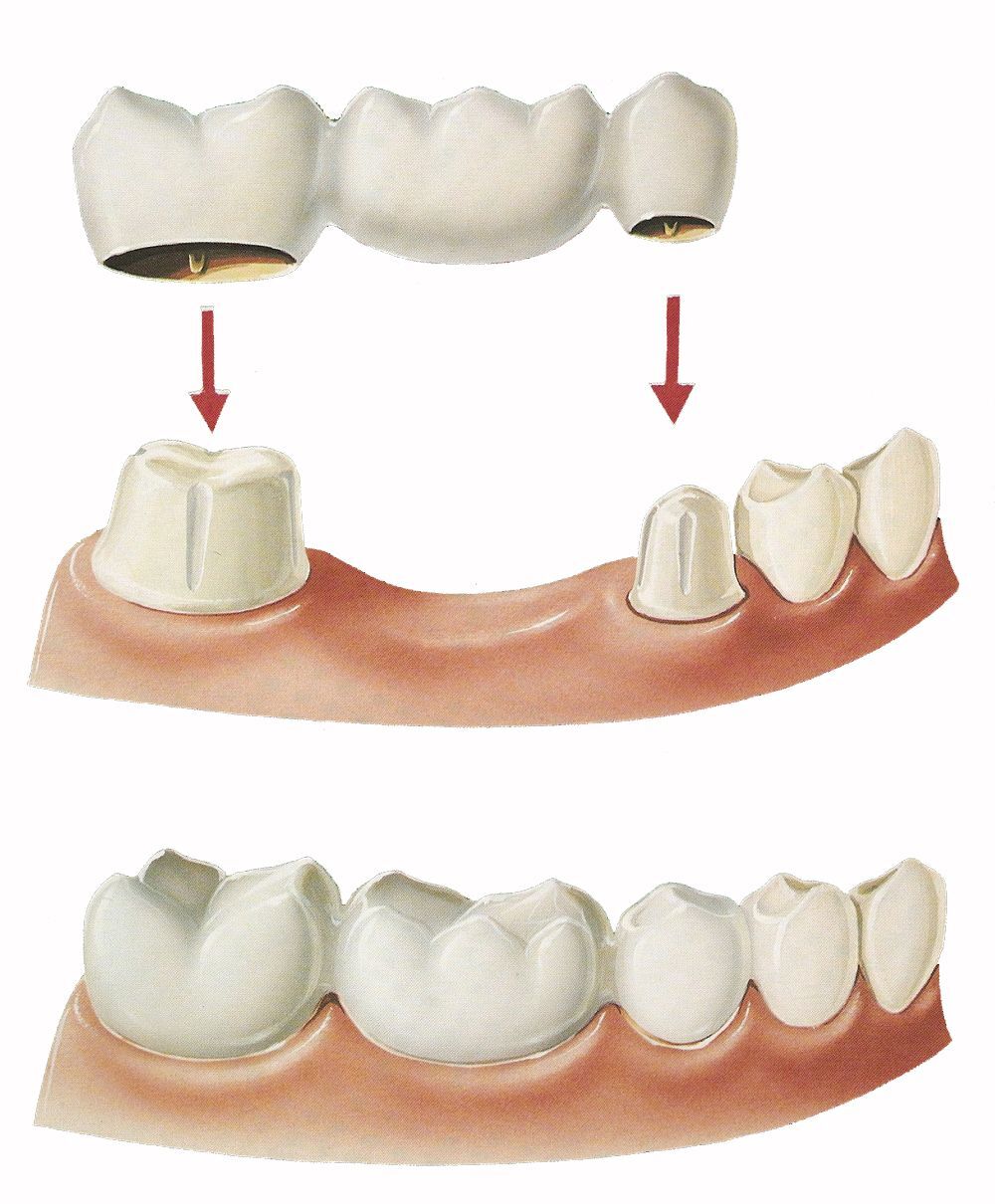 New York, Dental, Trusted Brooklyn Dentist | Natural-Looking Crowns & Bridges
