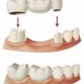 Trusted Brooklyn Dentist | Natural-Looking Crowns & Bridges