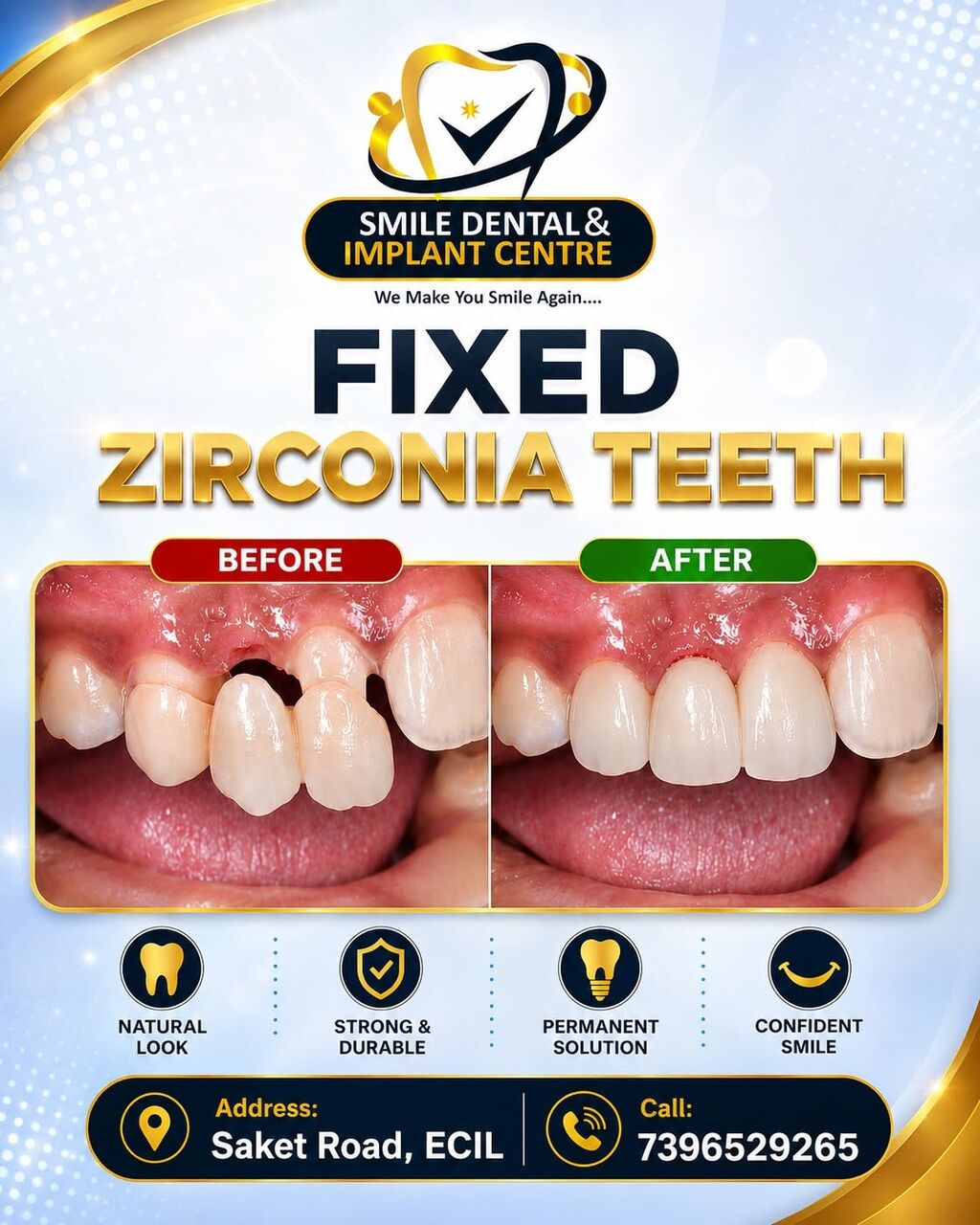 Hyderabad, Dental, Get Fixed Zirconia Teeth In AS Rao Nagar & ECIL | Permanent Smile Makeover