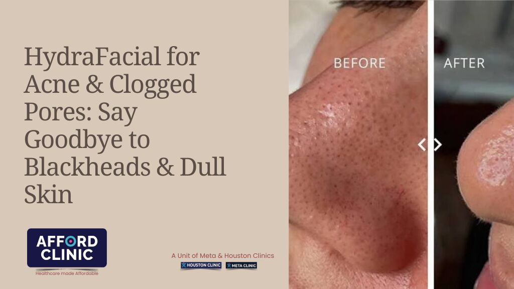 Al Nahda, Health, HydraFacial For Acne & Clogged Pores: Say Goodbye To Blackheads & Dull Skin
