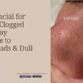 HydraFacial For Acne & Clogged Pores: Say Goodbye To Blackheads & Dull Skin