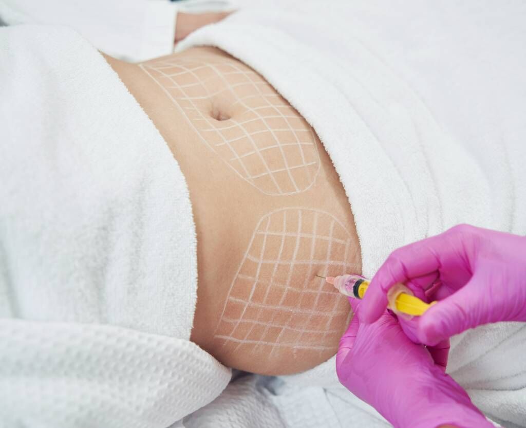 Toronto, Beautician, Non Surgical Body Fat Dissolving Treatment | Targeted Fat Reduction