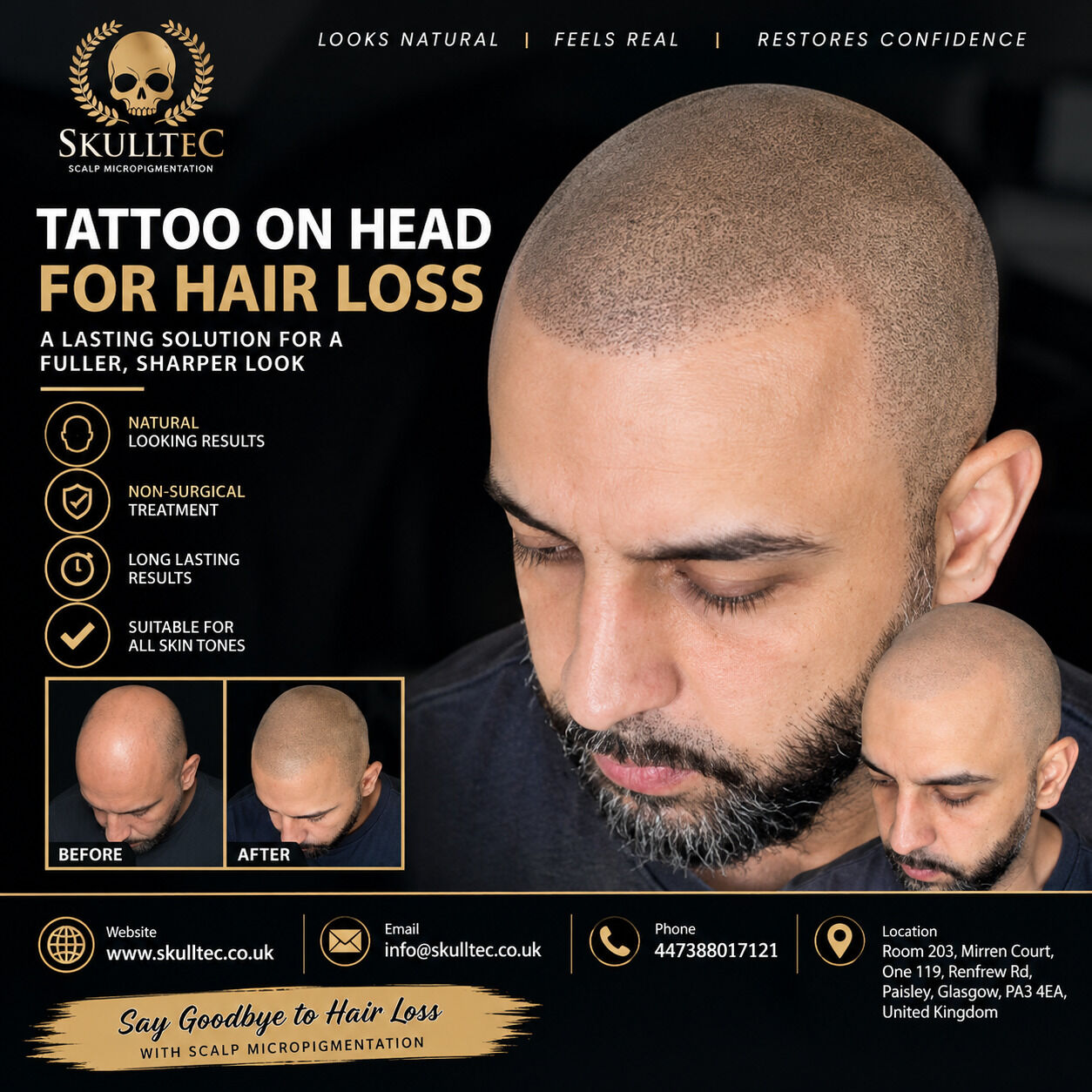 London, Health, Hair Tattoo For Hair Loss &ndash; Natural-Looking Scalp Micropigmentation