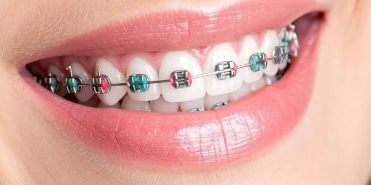 New York, Dental, Braces Oxnard &ndash; Personalized Orthodontic Care