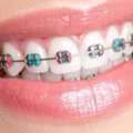 Braces Oxnard &ndash; Personalized Orthodontic Care