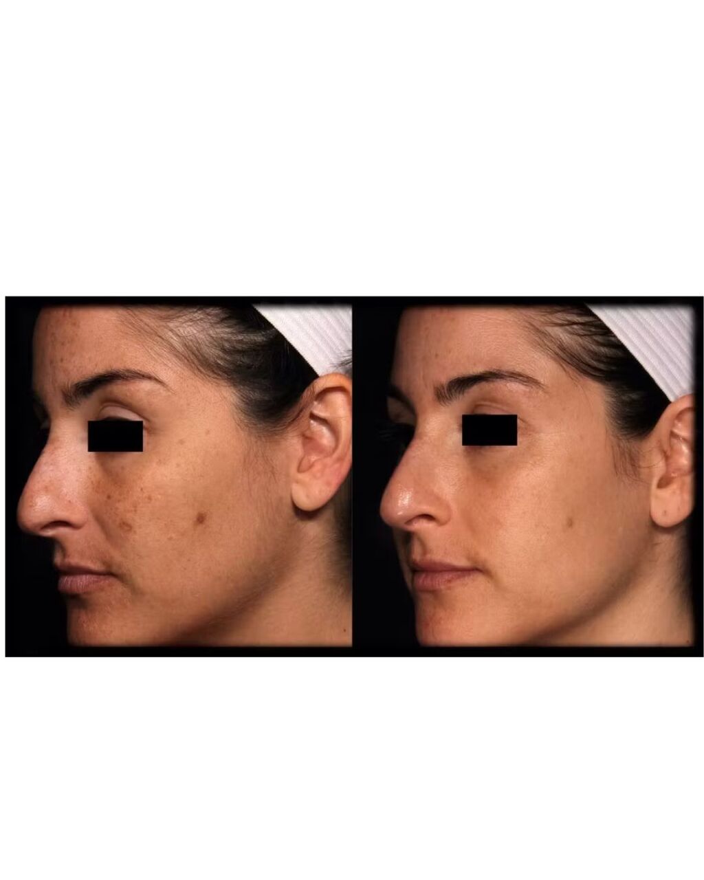 New York, Health, Tranexamic Acid Melasma Therapy