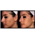Tranexamic Acid Melasma Therapy