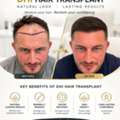 DHI Hair Transplant In UK