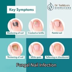 Kurnool, Health, Fungal Nail Symptoms And Treatment At Dermacure - Rajahmundry