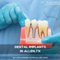 Get Dental Implants In Allen, TX Restore Your Smile Confidence