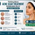 INR 2499,  Acne Scar Treatment In Banjara Hills &ndash; Check The Cost Before You Decide