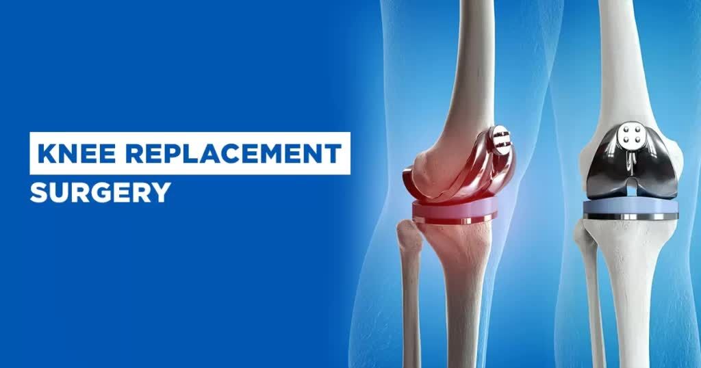 Noida, Health, Knee Replacement Surgery In India For Better Mobility