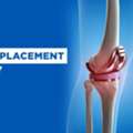 Knee Replacement Surgery In India For Better Mobility