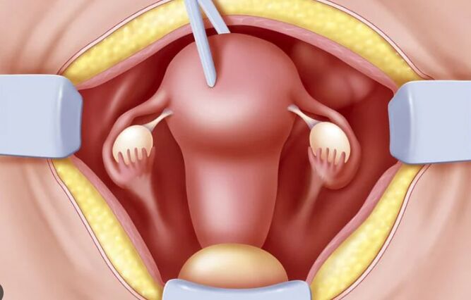 Gurgaon, Health, Uterus Removal Surgery In Gurgaon: When Is It Considered