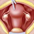 Uterus Removal Surgery In Gurgaon: When Is It Considered