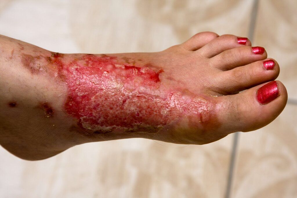 New York, Health, Burns And Sun Burn Relief From California Dermatology Experts