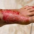 Burns And Sun Burn Relief From California Dermatology Experts