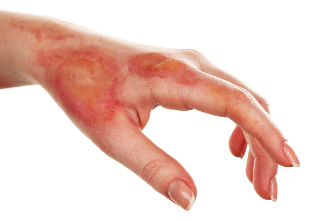 New York, Health, Burns And Sun Burn Relief From California Dermatology Experts