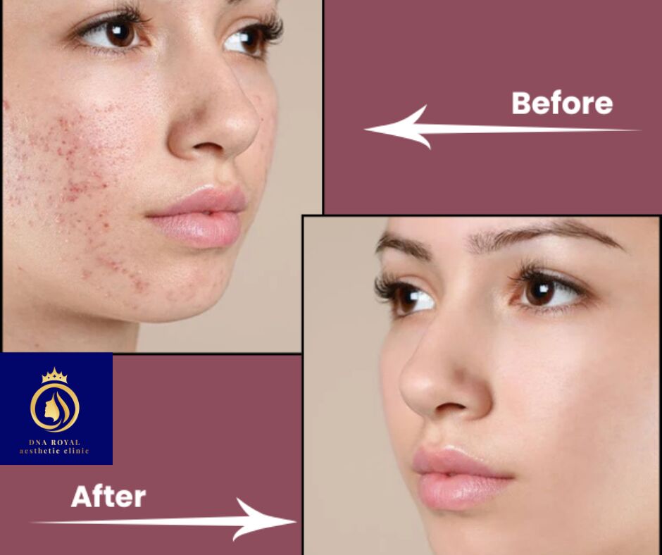 Thane, Fashion & Design, Professional Laser Resurfacing Treatment In Thane &ndash; DNA Royal Experts.
