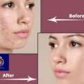 Professional Laser Resurfacing Treatment In Thane &ndash; DNA Royal Experts.