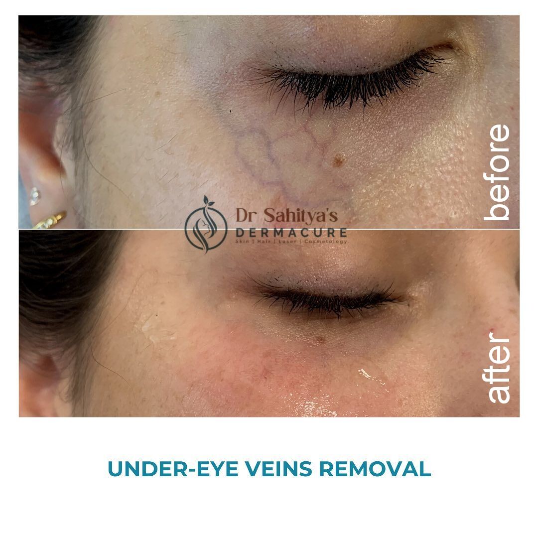 Kurnool, Health, Under Eye Veins Treatment At Dermacure - Rajahmundry