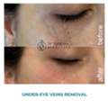 Under Eye Veins Treatment At Dermacure - Rajahmundry