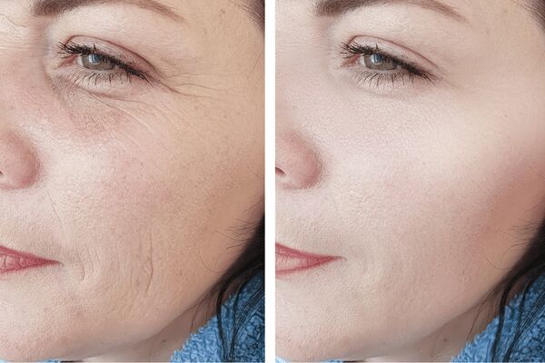 Mumbai, Health, Skin Booster Treatments In Bengaluru Near Me